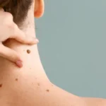 The Benefits of Getting a Skin Check Regularly