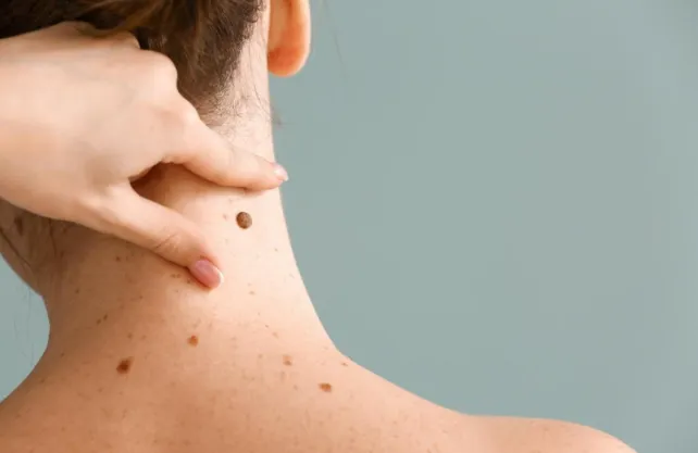 The Benefits of Getting a Skin Check Regularly